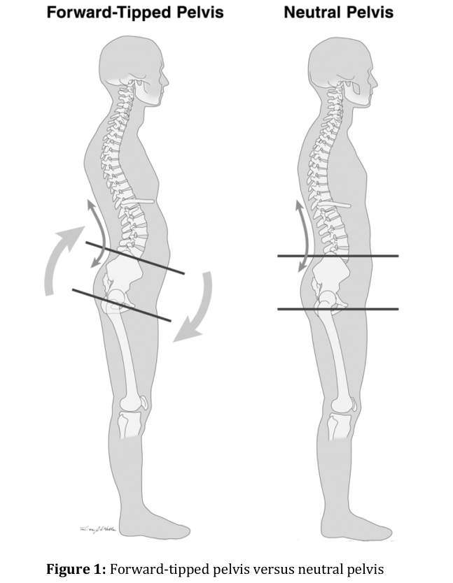 Forward Tipped Pelvis vs Neutral Pelvis