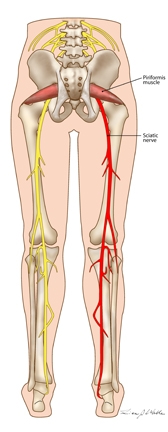 sciatica causes