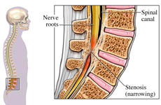 osteoarthritis