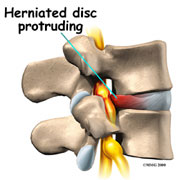 herniated disc