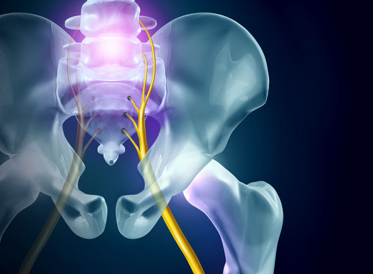 how long does sciatica last?