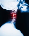 Neck Pain Herniated Disc