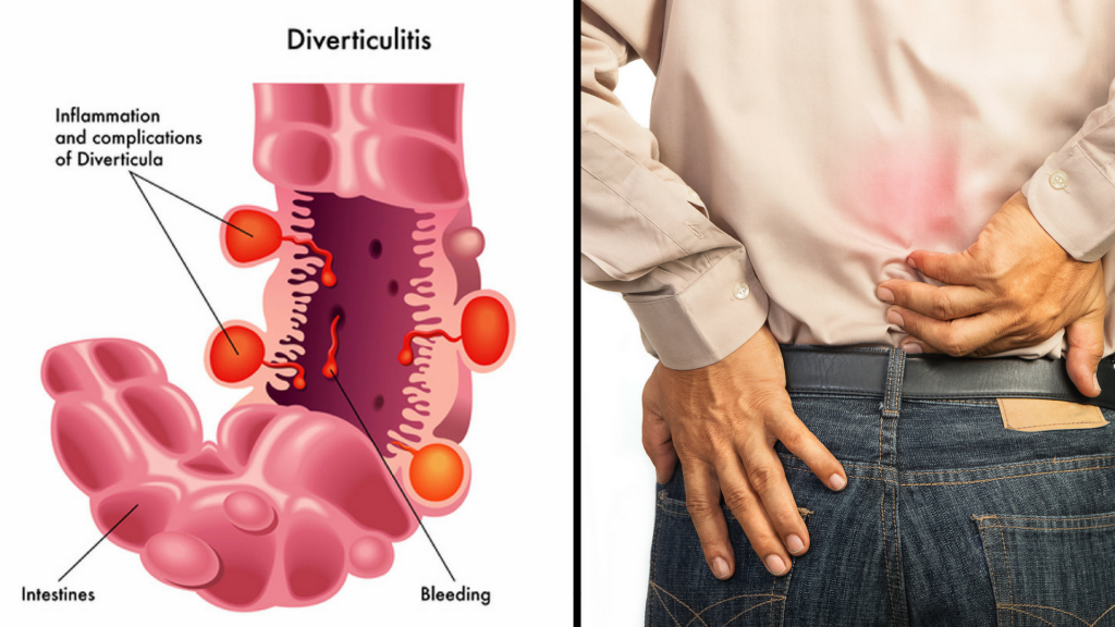 diverticulitis-and-low-back-pain-5-common-complications-treatments