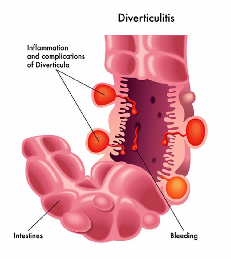 Diverticulitis and Low Back Pain 5 Common Complications Treatments