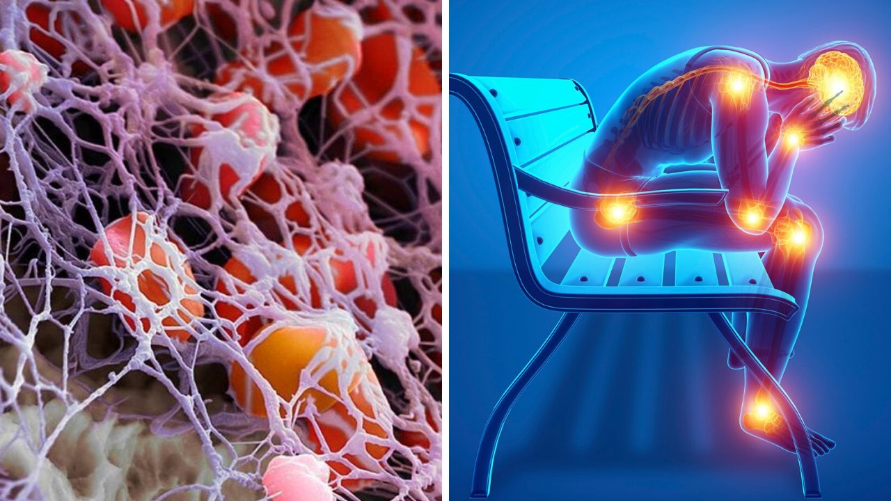 Fibrin: What It is and What to Do About It Now to Stop Pain