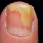 Ridges in Fingernails: 8 Health Warnings Your Fingernails May Be Sending