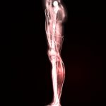 Sciatic Pain