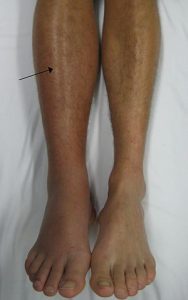 leg deep vein thrombosis (dvt)