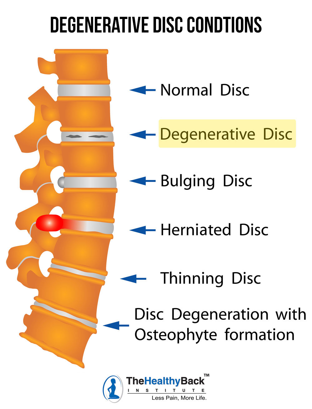 degenerative disc disease, degenerative disc conditions