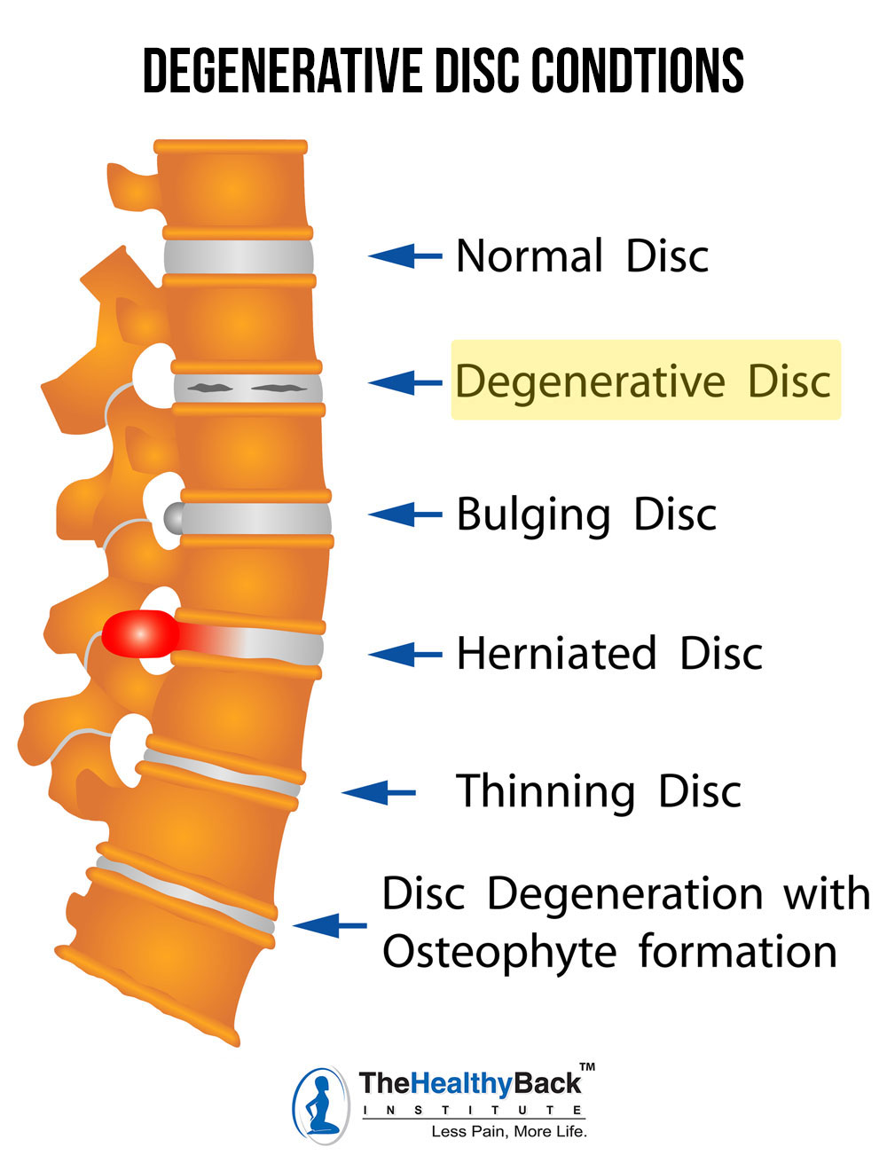 Degenerative Disc Disease Causes Symptoms And Treatments Degenerative Disc Disease Causes Symptoms And Treatments