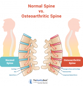 Spinal Arthritis: Causes, Symptoms and Treatments