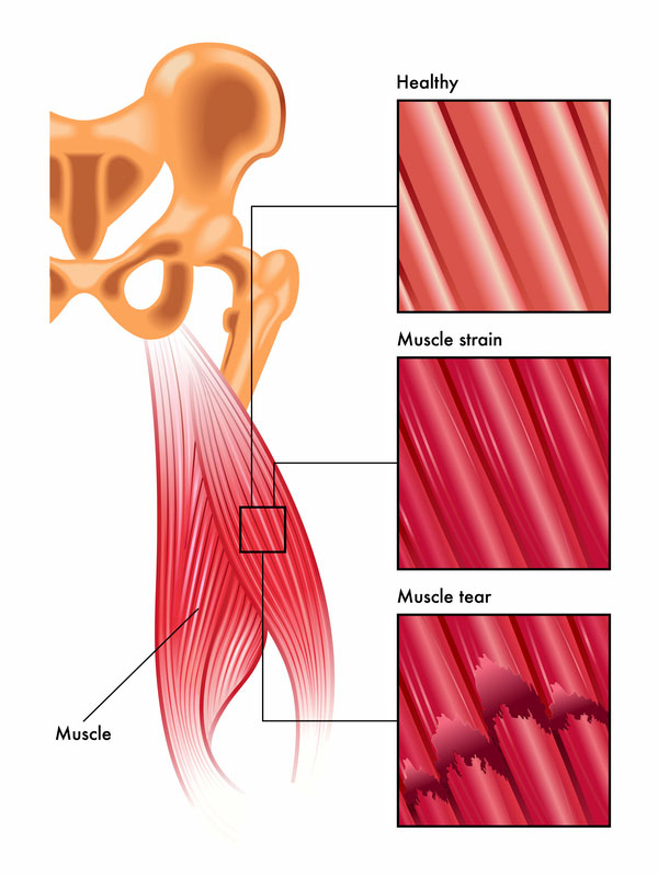 muscle strain muscle tear