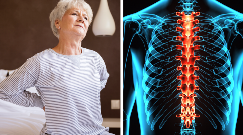 spinal arthritis