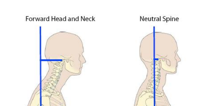 forward head posture