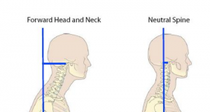 Forward Head Posture: What Causes It and the Best Ways to Treat It