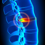 10 Natural Herniated Disc Treatments That Don’t Require Surgery