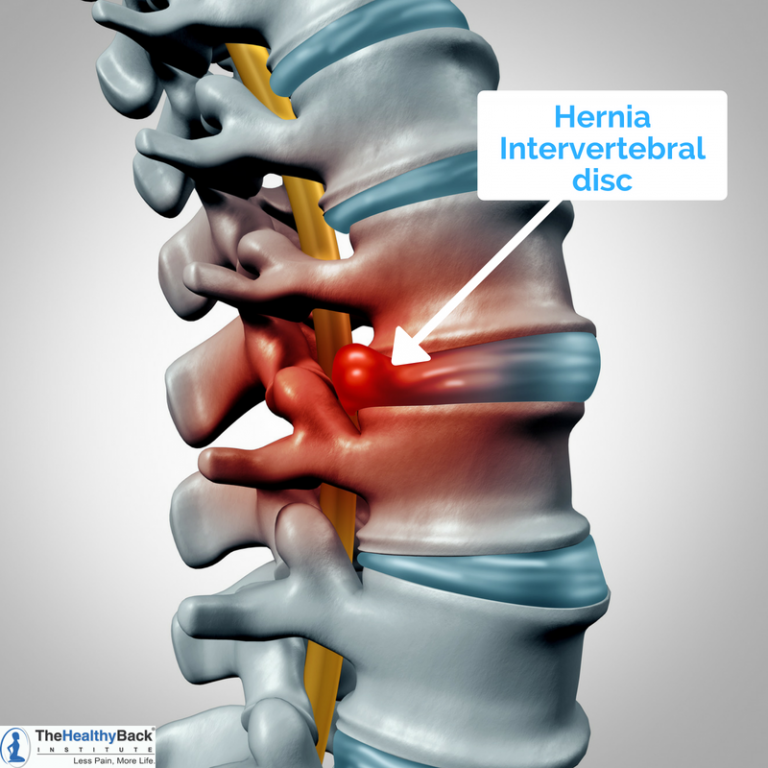 10 Natural Herniated Disc Treatments That Don't Require Surgery