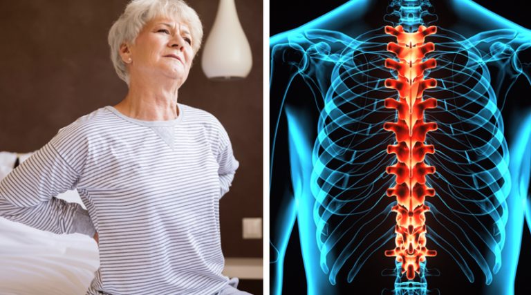 Spinal Arthritis Causes Symptoms And Treatments